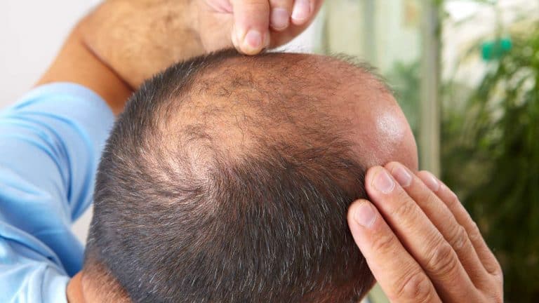 hair loss treatment for men